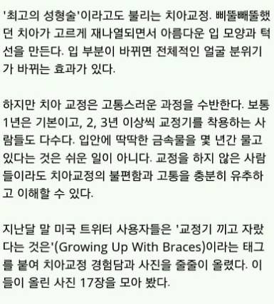 치아교정의 고통 ㄷㄷㄷ.jpg | 인스티즈