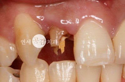 잇몸 고름주머니 신경치료 과정 : 네이버 블로그