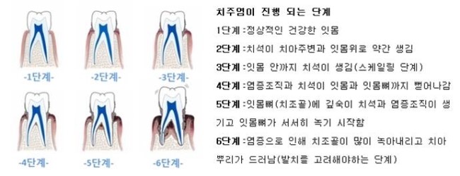 잇몸 고름주머니 치료방법! : 네이버 블로그