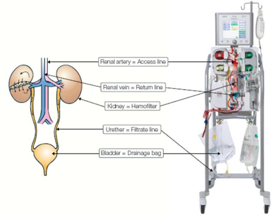 쉽게 이해하는 CRRT(Continuous Renal Replacement Therapy) 네이버 블로그